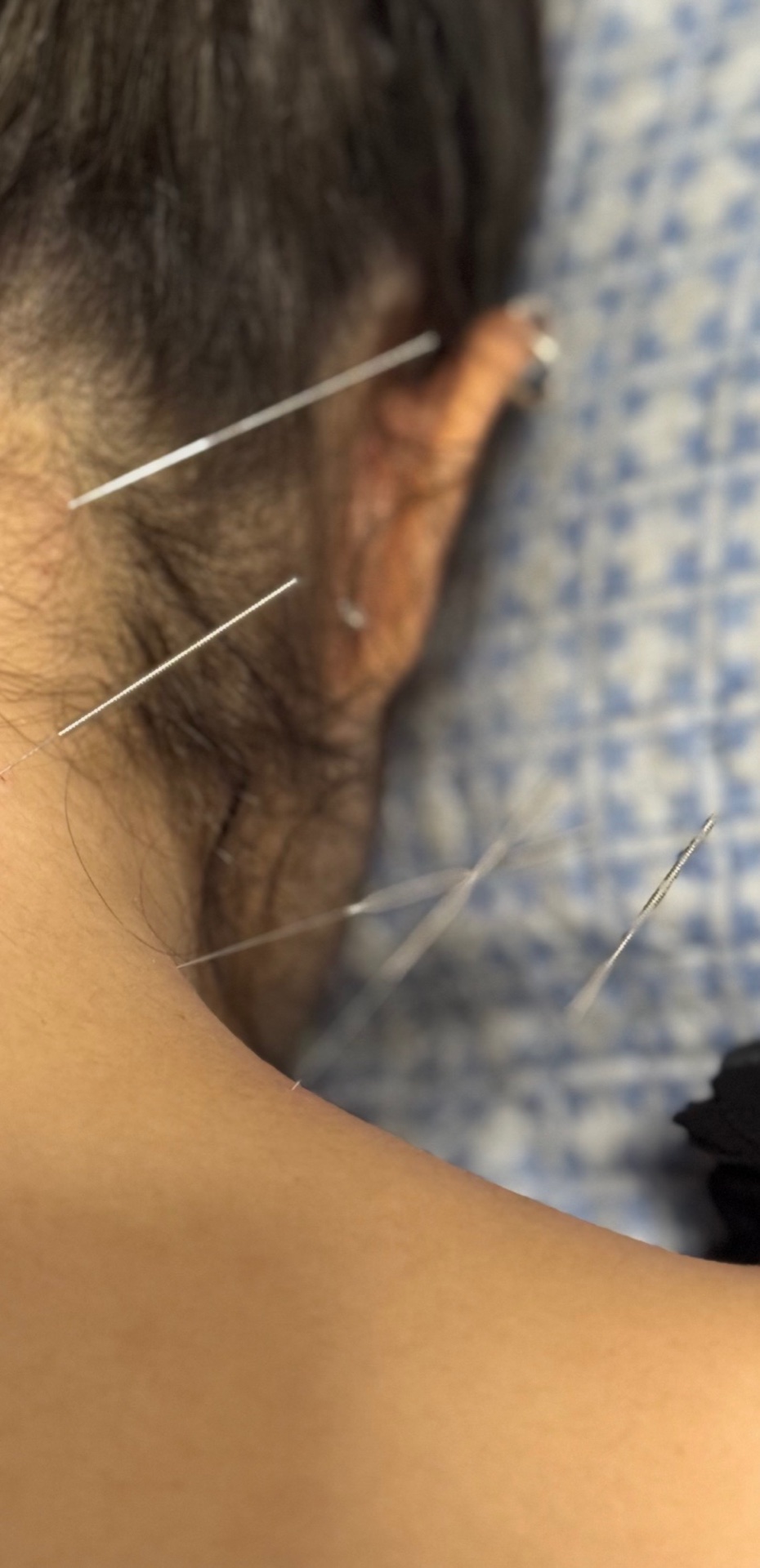 Acupuntura Médica / Agulhamento